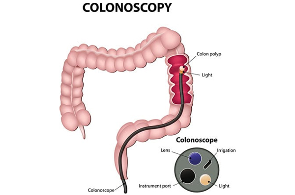 Sigmoidoscopy and Colonoscopy