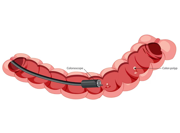 Therapeutic Colonoscopy Polypectomy