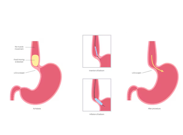 Endoscopic Stricture Dilatation of Esophagus