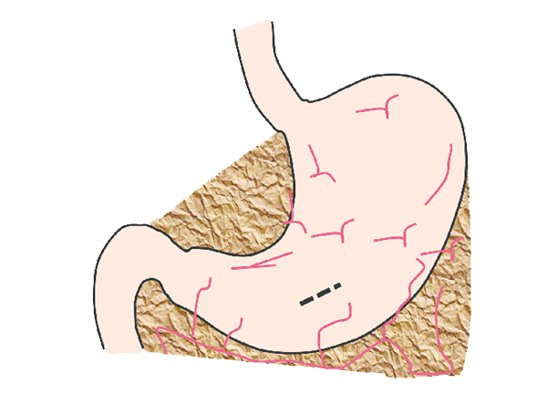 Gastrointestinal Foreign Body Removal