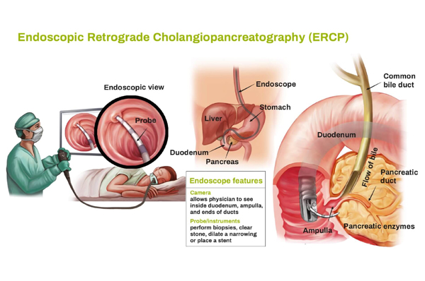 Endoscopic Endoscopic Retrograde Cholangiopancreatography