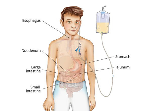 Jejunal Tube Placement