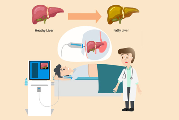 Fibroscan