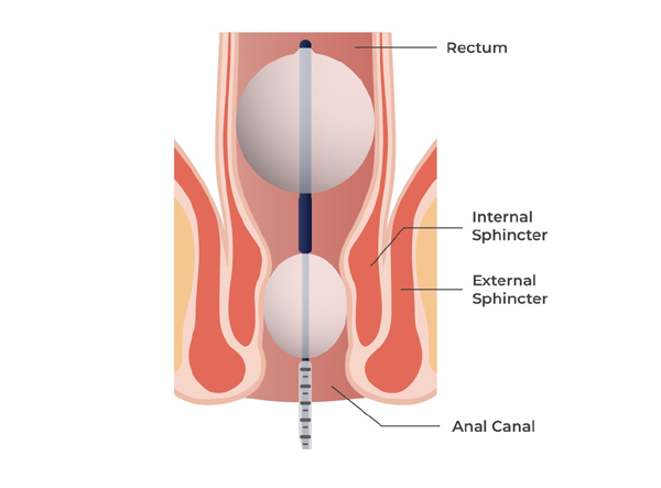 Anorectal Manometry